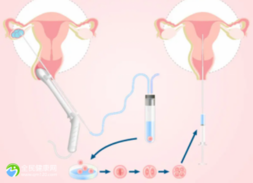 人工授精与试管婴儿的差异及费用详解